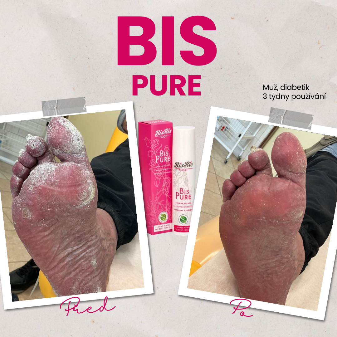 Bis Pure proměna diabetik